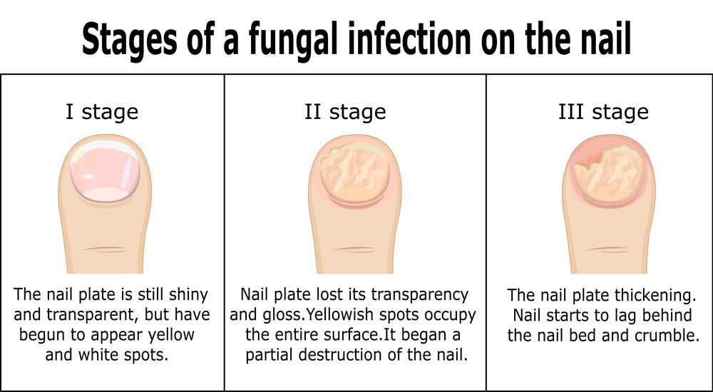 stages of fungal nail infection