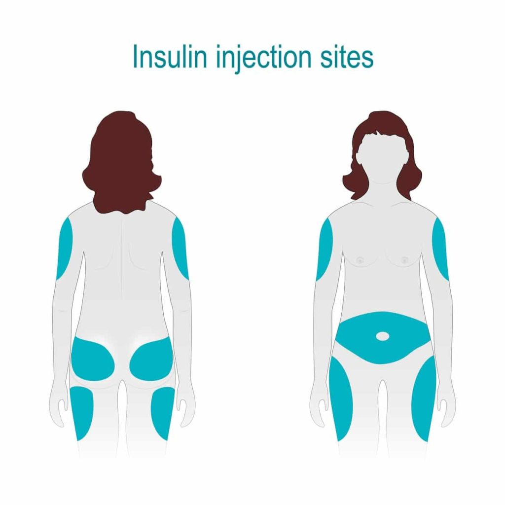 insulin injection sites