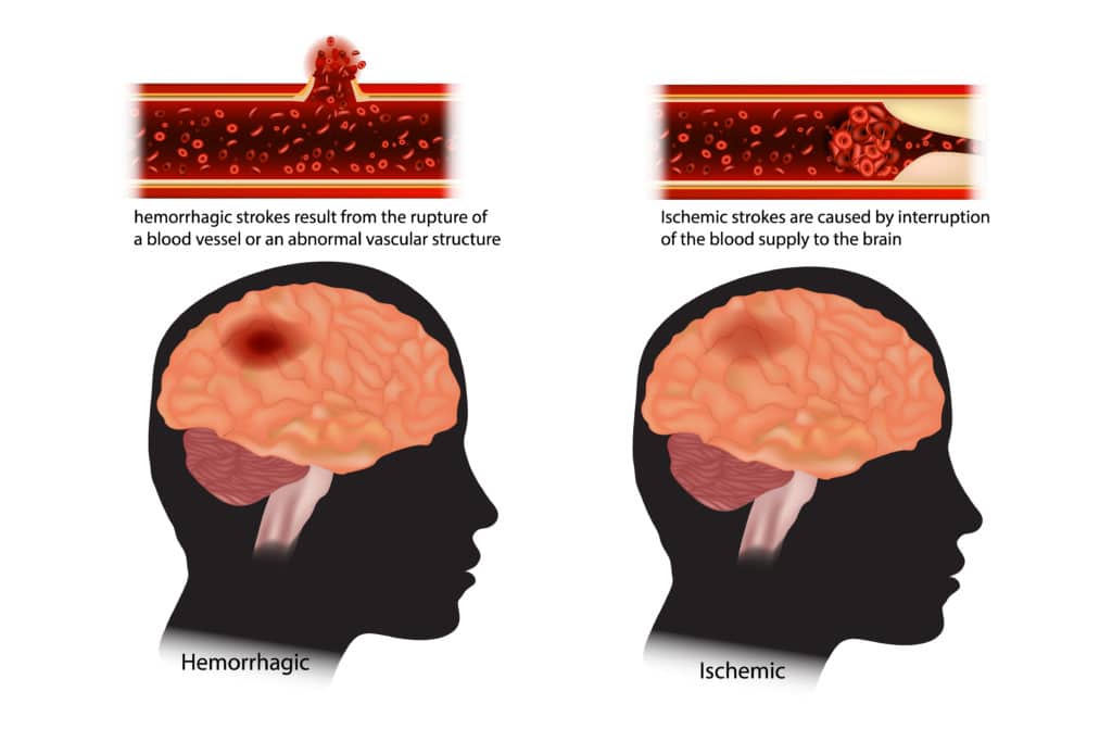 haemorrhagic vs Ischaemic stroke