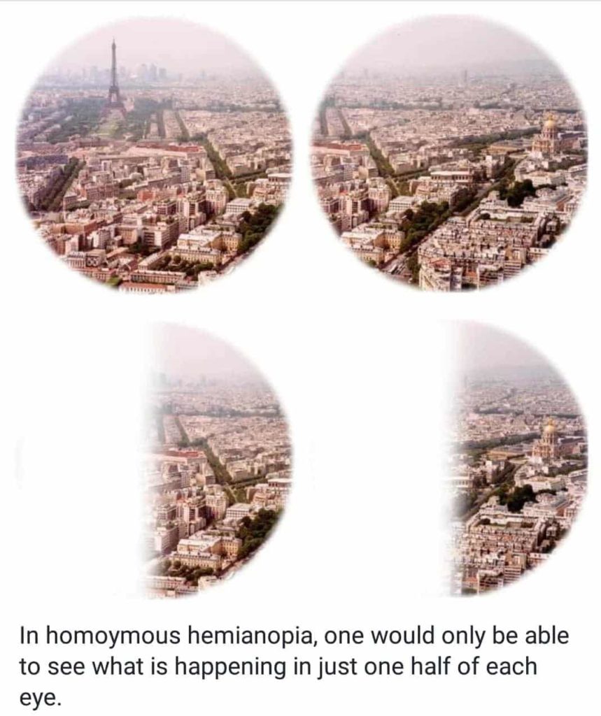 homoymous hemianopia