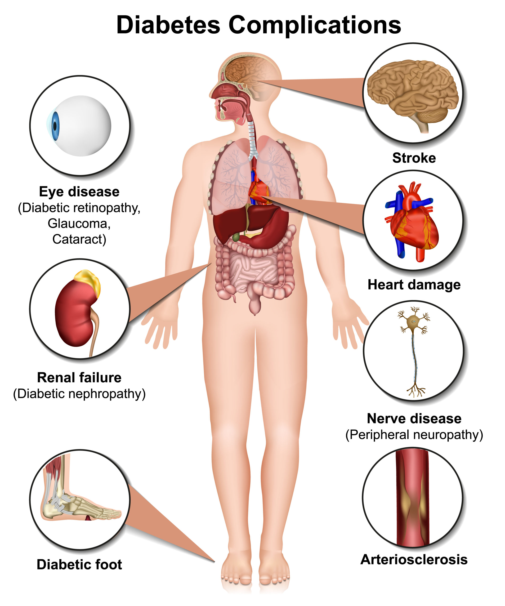 Complications of diabetes scaled