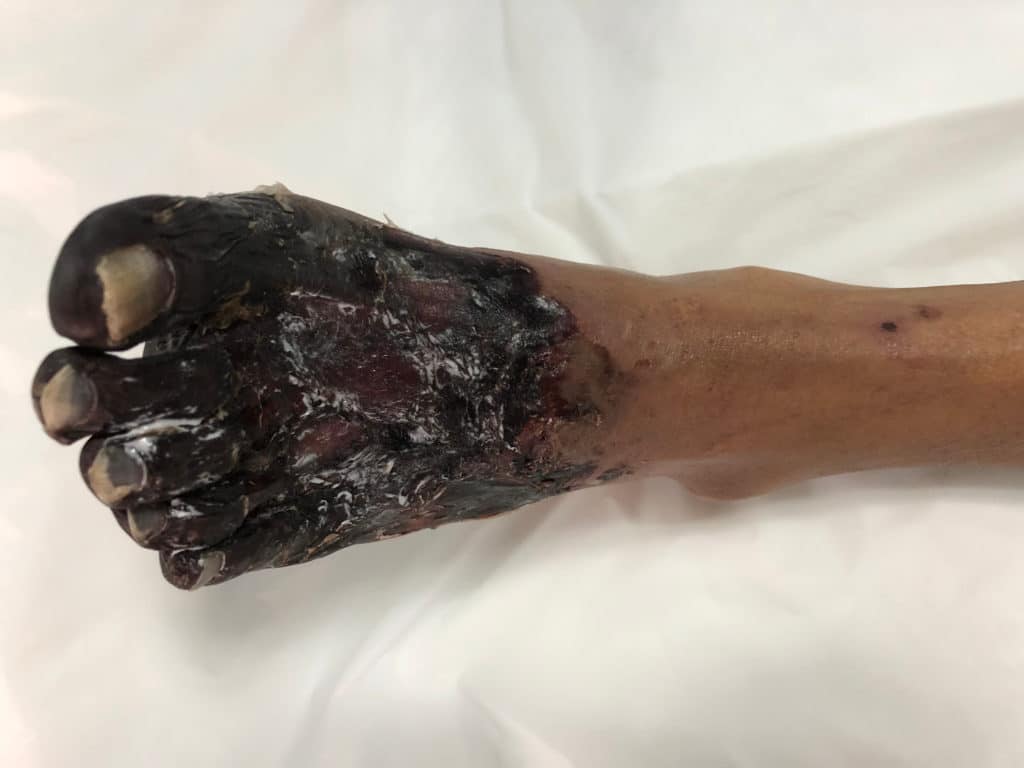 diabetic foot ulcers can cause foot gangrene
