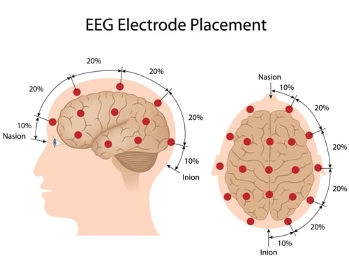 EEG for diagnosis of epilepsy