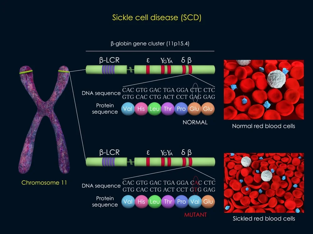 abnormal haemoglobin formation in sickle cell disease