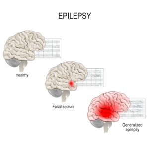 focal and generalised seizures