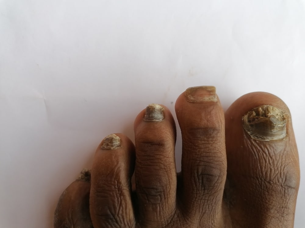 fungal nail infection pictures