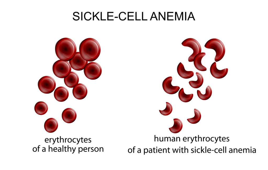 normal vs sickle red blood cell