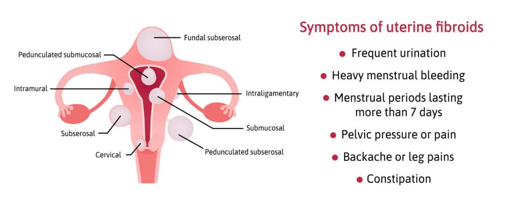 symptoms of fibroids