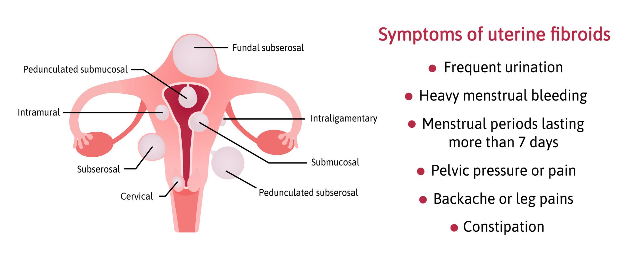 wandering fibroid definition