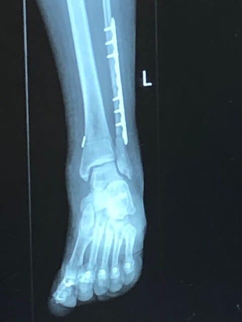 ankle fracture 6 weeks