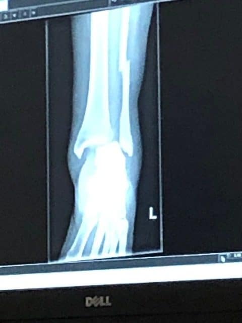 ankle fracture x ray