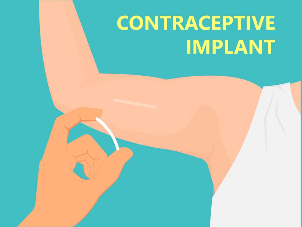 birth control implant in arm