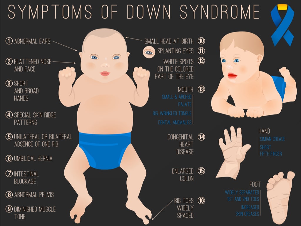 symptoms of down syndrome