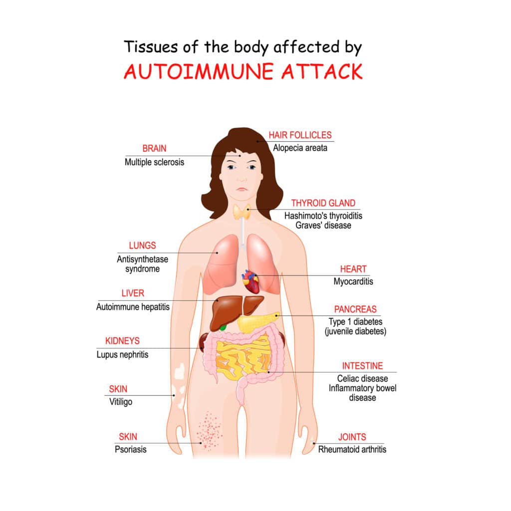 autoimmune disease list