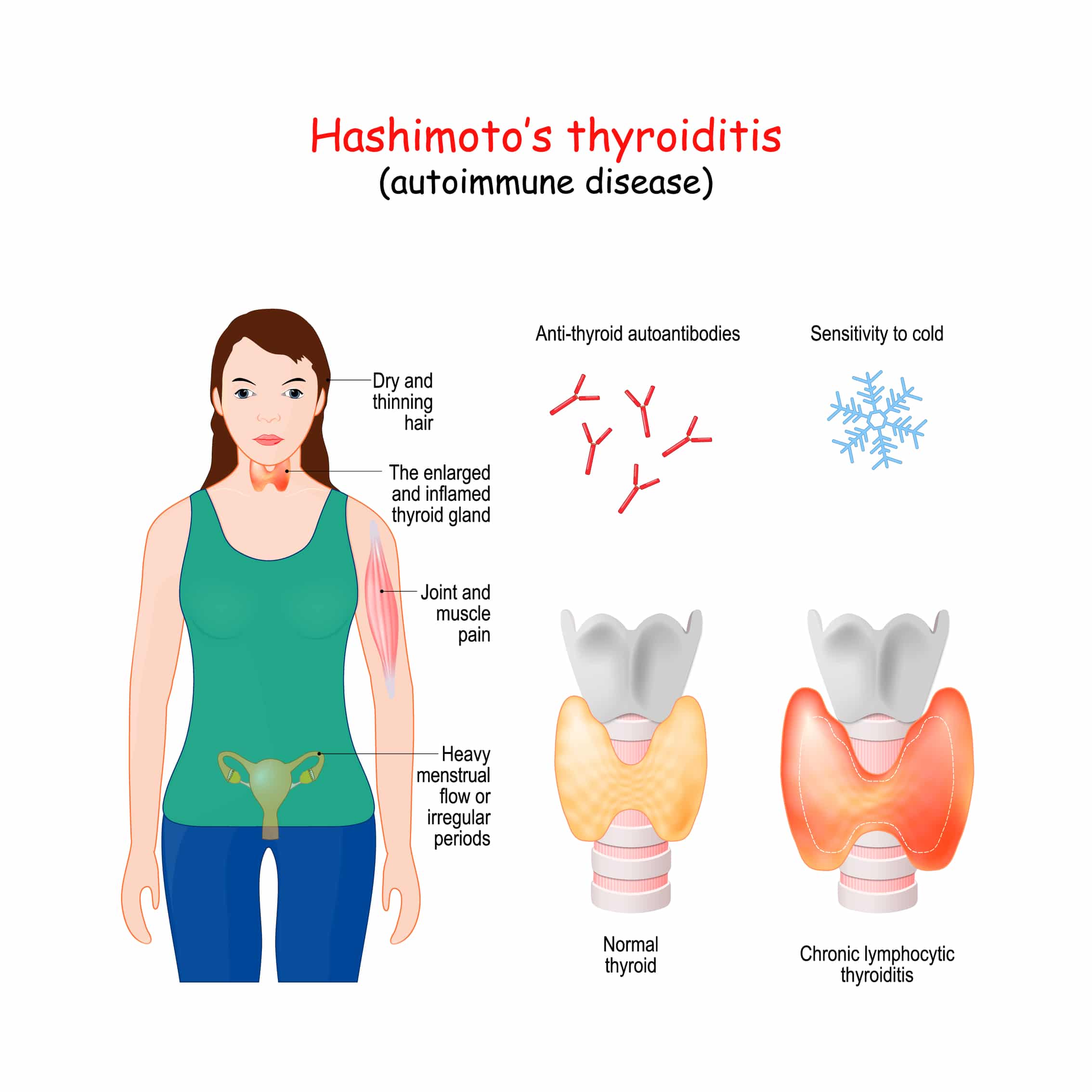 hashimotos disease