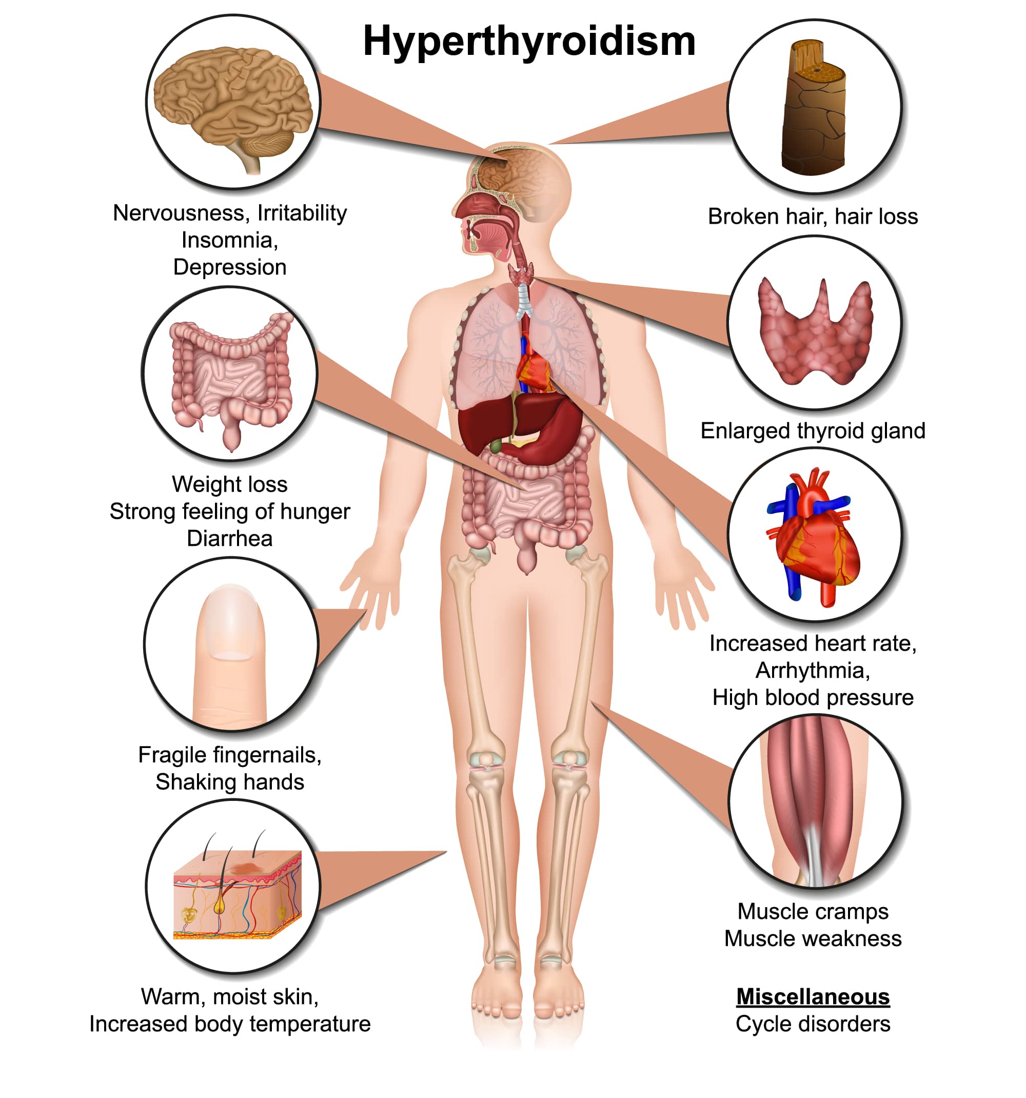 Hyperthyroidism (Overactive Thyroid) - Medic Drive