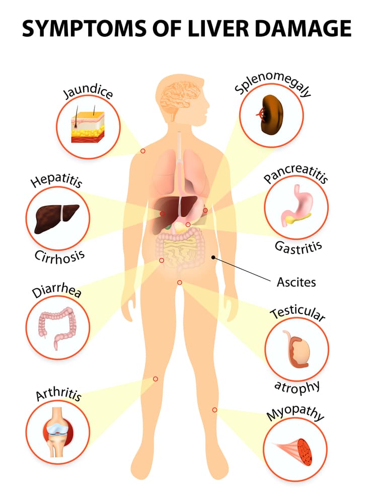 symptoms of liver Cirrhosis