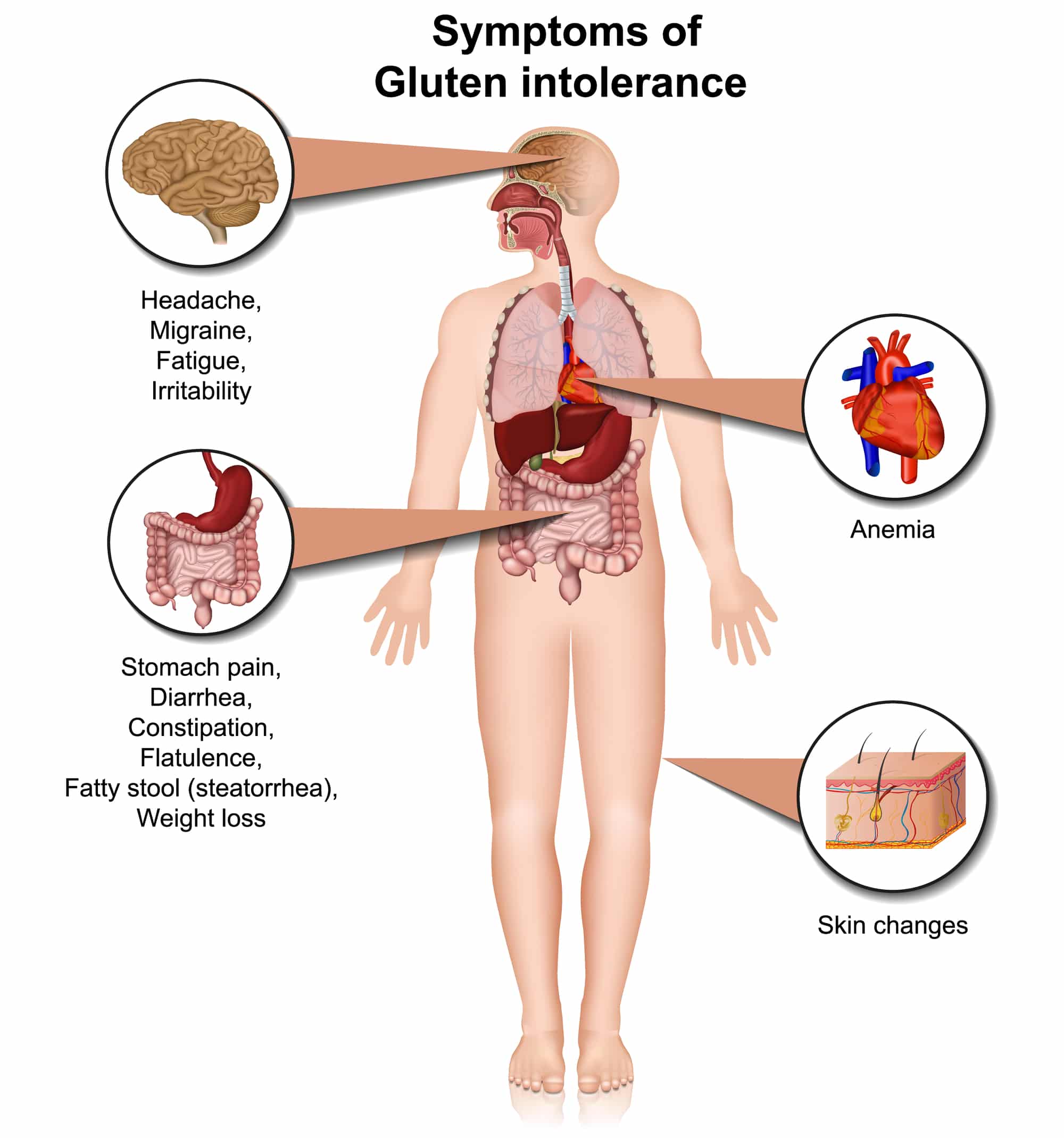 Symptoms of gluten intolerance