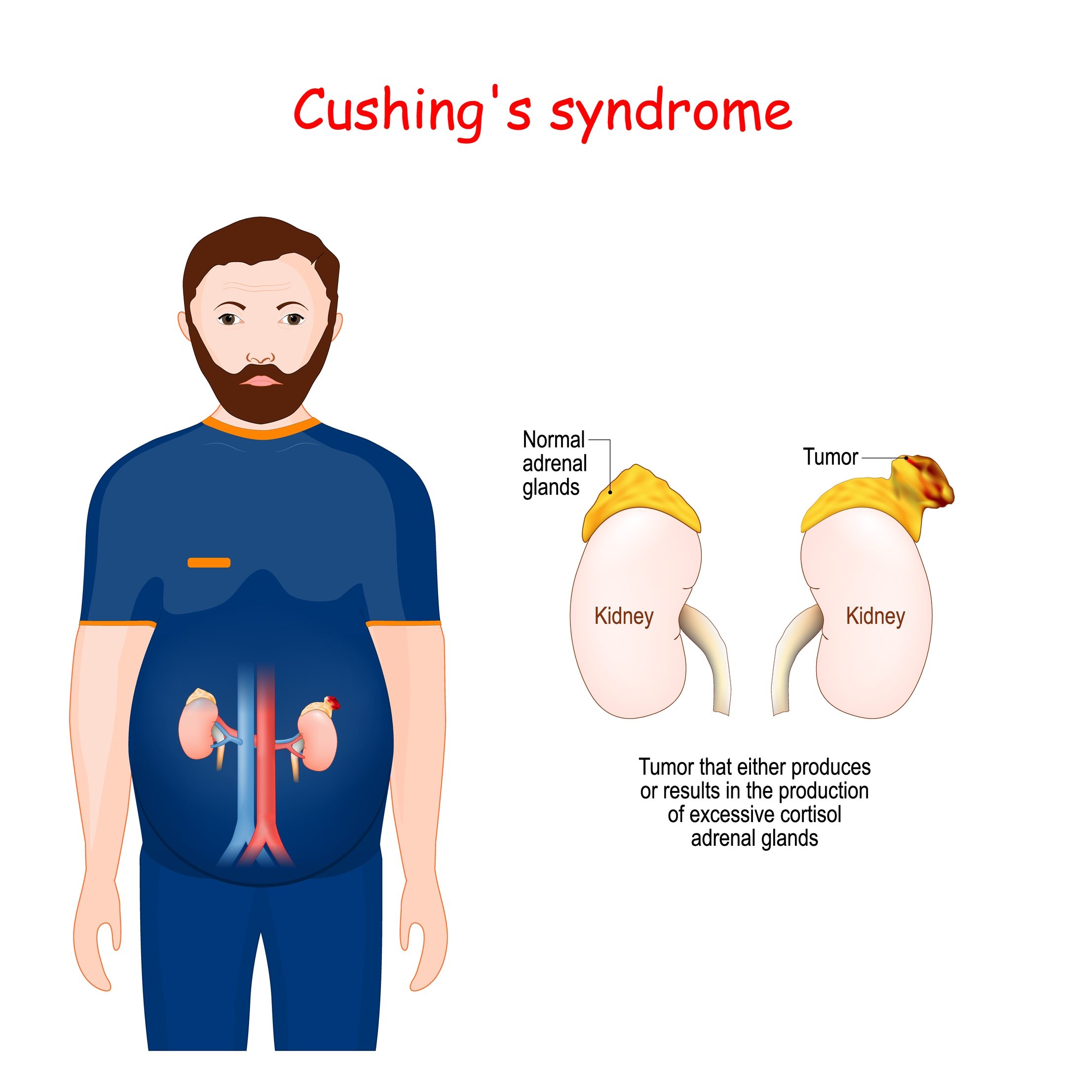 cushing's syndrome