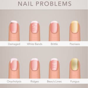 nail problems