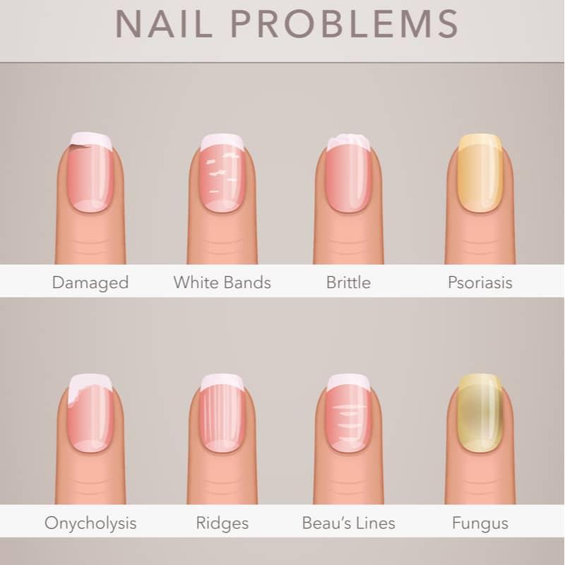 10 Nail Problems You Should Not Ignore - Medic Drive