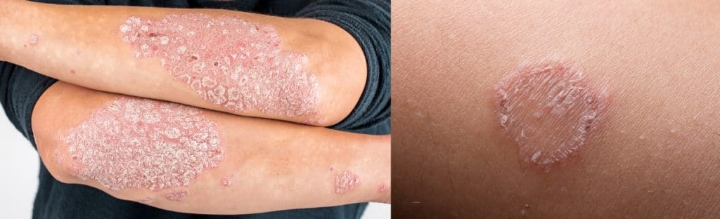 psoriasis or ringworm